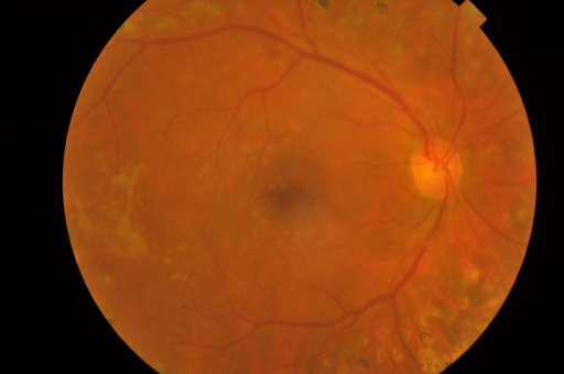 Proliferative